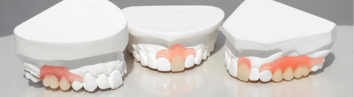 A set of 3 top dentures on a white counter.
