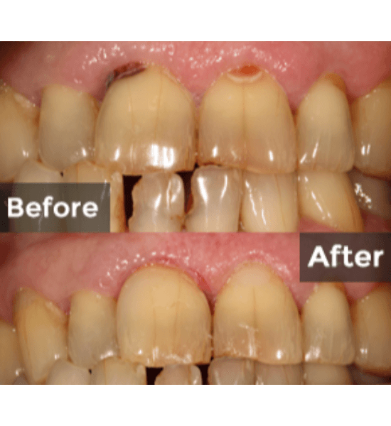 Before and after dental restoration showing repaired chipped and decayed front teeth with improved shape and overall oral health.