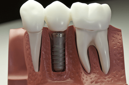 Dental implant model showing titanium implant placed in the jawbone between two natural teeth.
