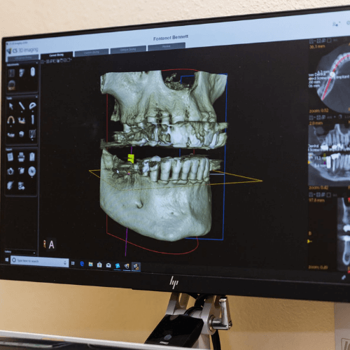 Computer with xray of teeth
