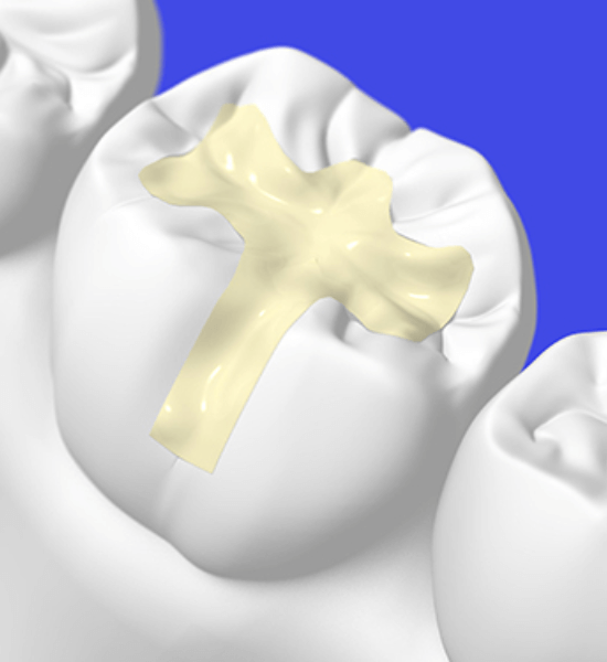 Dental sealant applied to a molar to protect against cavities and tooth decay.