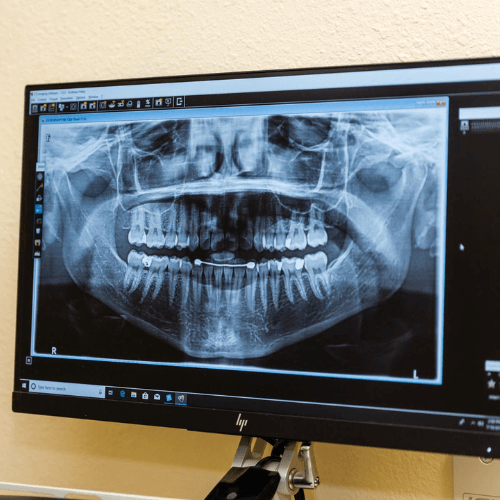 Panoramic dental X-ray image displayed on a monitor during a dental exam.